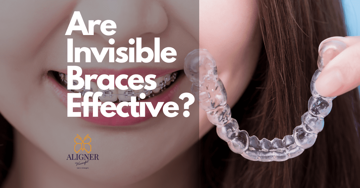 Are Invisible Braces Effective Facts To Know Before Try