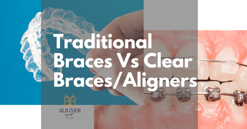 traditional braces vs clear braces by alignerwisecomort Malaysia