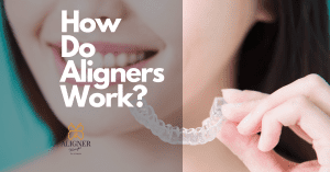 How Do Aligners Work? A perfect smile & aligned teeth lady holding an invisible aligners.