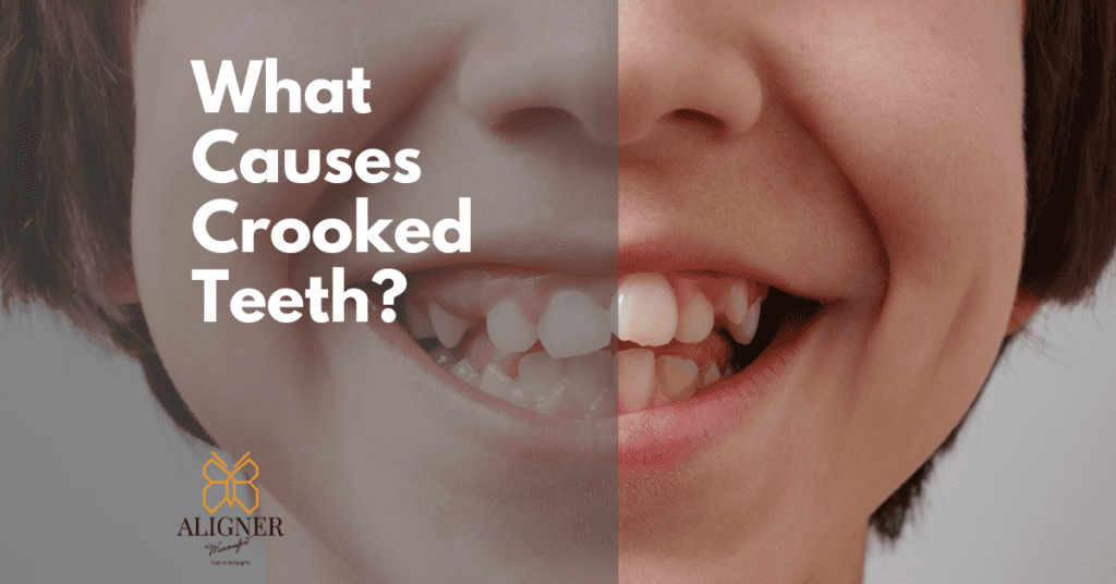 What causes crooked teeth
